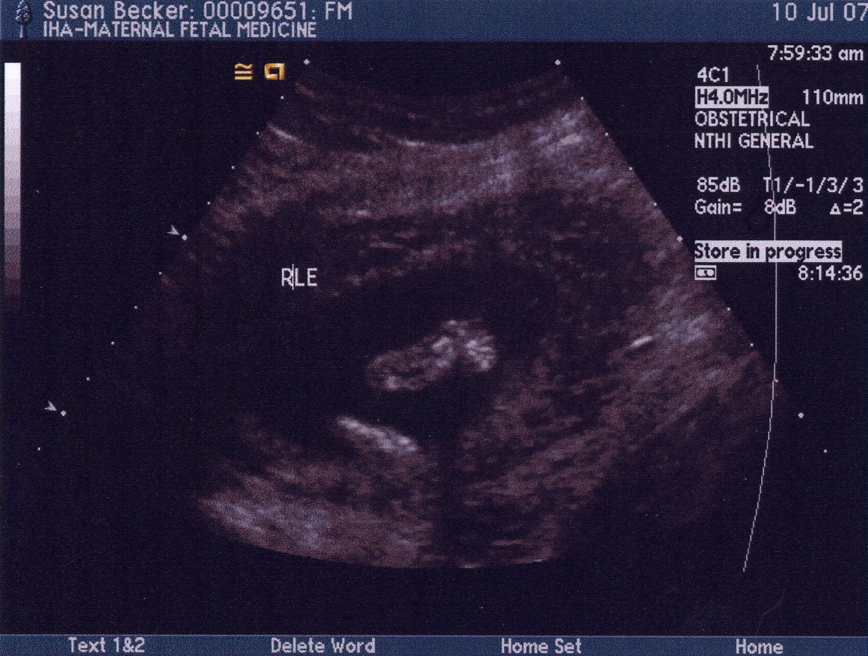 Second Ultrasound - Leg