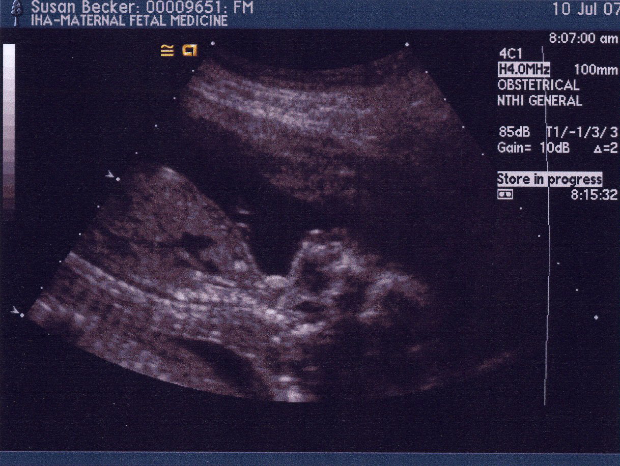 Second Ultrasound - Profile