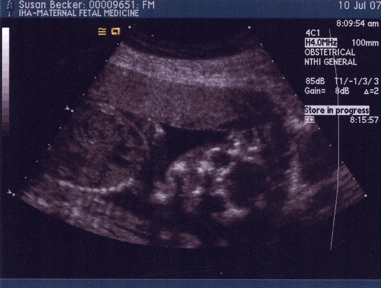 Second Ultrasound - Face