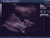 Second Ultrasound - Profile