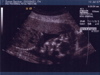 Second Ultrasound - Face