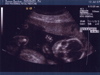 Second Ultrasound - Fist